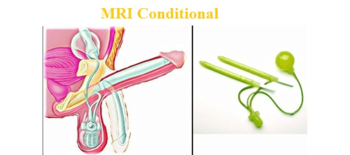 Ampliación cirúrxica do pene mediante implante