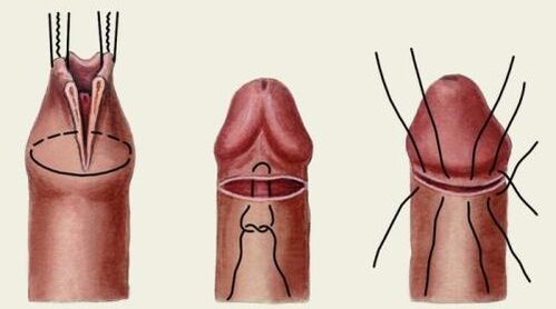 Como se realiza a cirurxía plástica do pene
